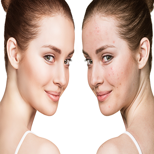 Comparison portrait of young girl with problematic skin before and after treatment